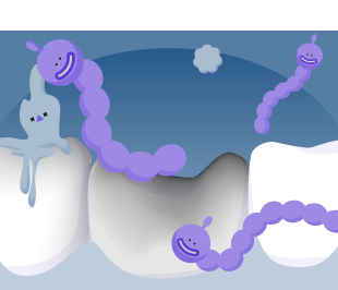 Vi khuẩn chuyển hoá đường thành axit ăn mòn men răng và gây sâu răng